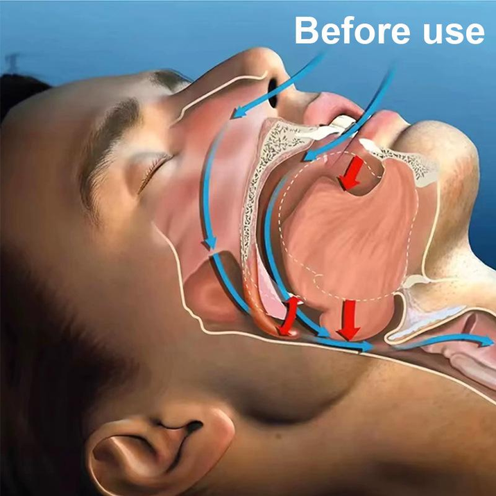 Everest Queen Mouth Tape, for Sleep One Month Supply, Mouth Tape, Pink, Gentle, Adhesion, 30 Strips, Sports Accessories,