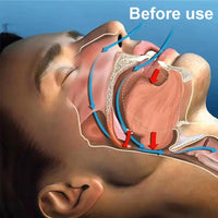 Everest Queen Mouth Tape, for Sleep One Month Supply, Mouth Tape, Pink, Gentle, Adhesion, 30 Strips, Sports Accessories,